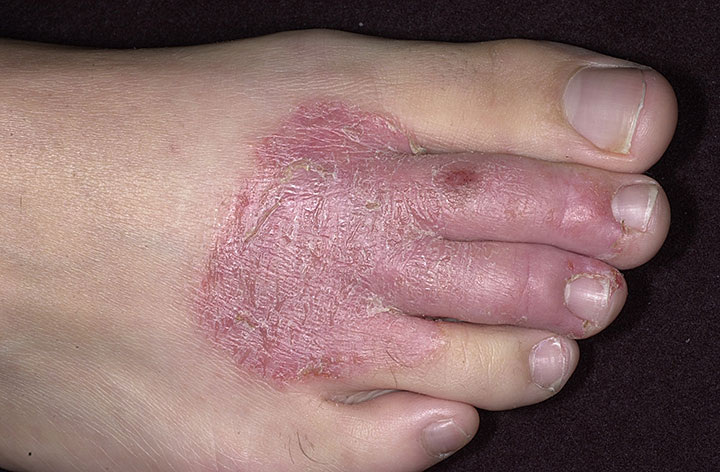 Image result for jangkitan fungus pada kulit